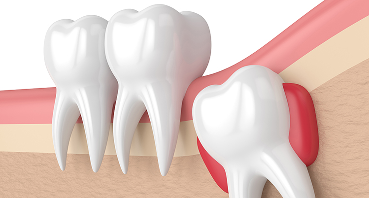 埋まっている親知らずのイメージ