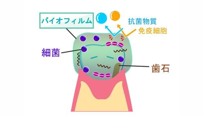 歯の周りに歯石・バイオフィルム・細菌がまとわりつくイメージイラスト