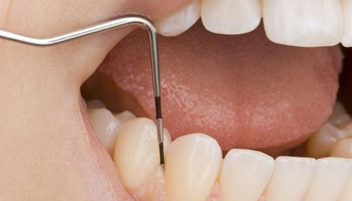 歯周病検査を受けている様子