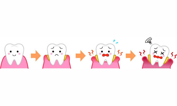 歯周病の進行に併せて4段階に分けて歯がダメになってゆくイラスト