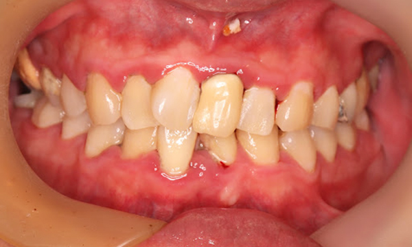 重度歯周病の歯ぐきの写真