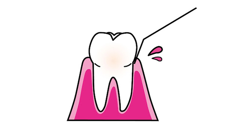 歯と歯ぐきの間を触り出血の有無を確認している様子のイラスト