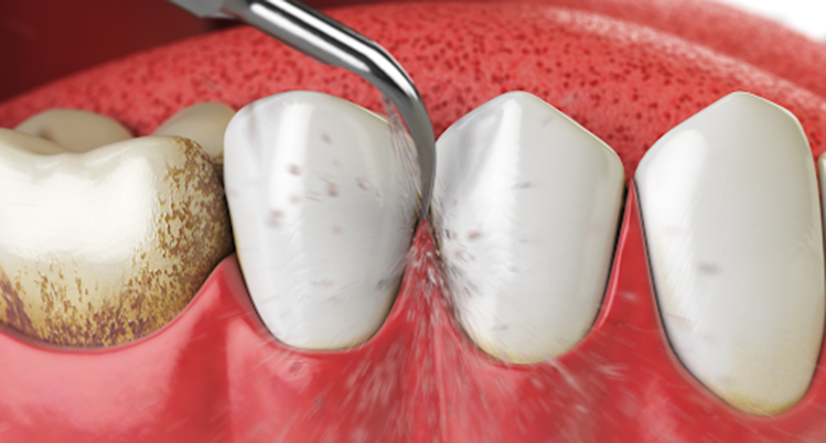 超音波の振動で汚れを落とすイメージイラスト