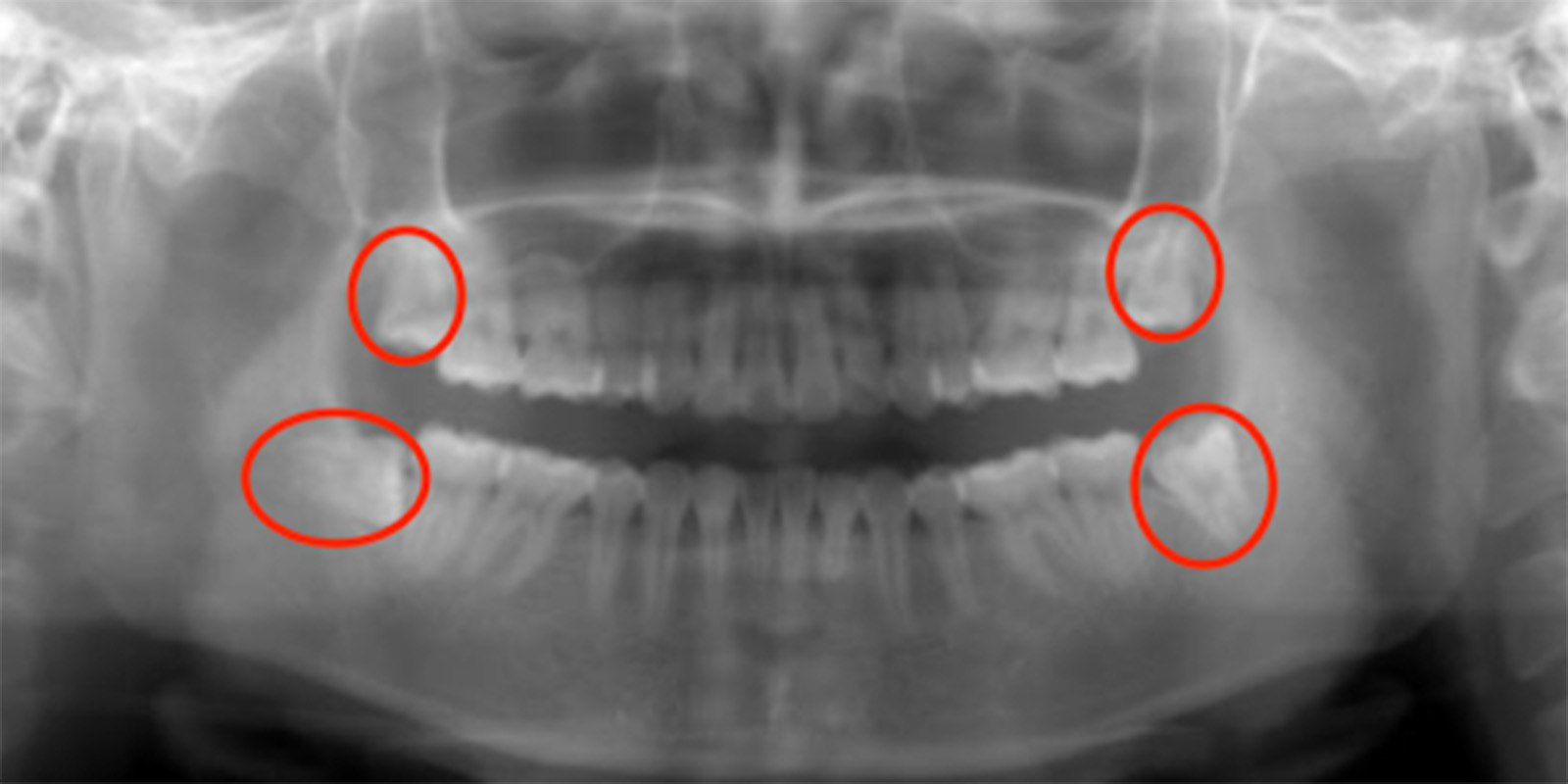 レントゲン画像の親知らず