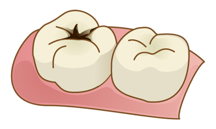 小さな虫歯になっている歯のイラスト