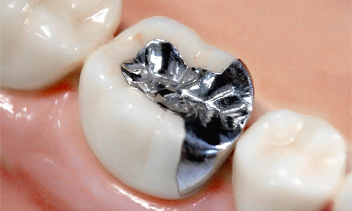 金属の詰め物が入った歯の模型