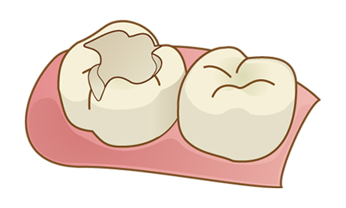 虫歯ができたために歯の一部分を削った歯のイラスト