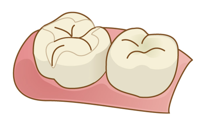 虫歯により削った歯の一部分に白い詰め物を入れたイラスト