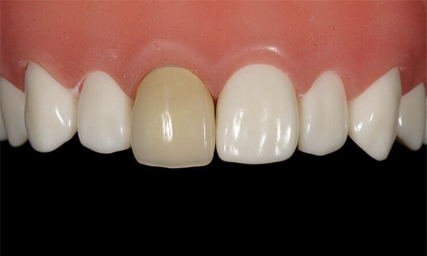 東松原歯科の前装冠