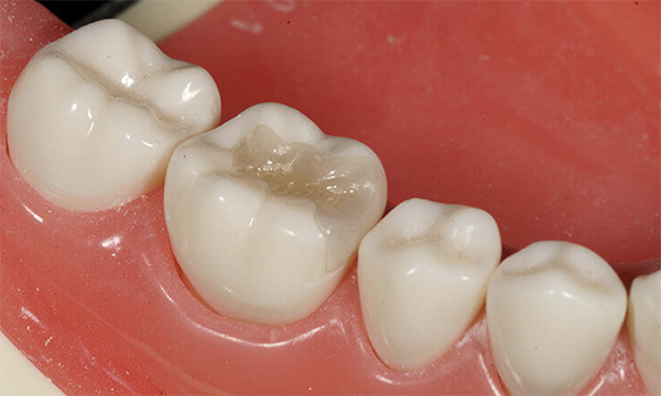 東松原歯科のジルコニアインレー