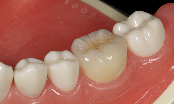 東松原歯科のジルコニアボンド