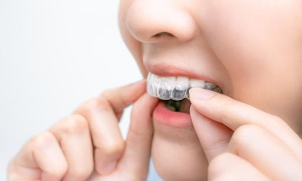 ホームホワイトニングのトレーを装着している女性