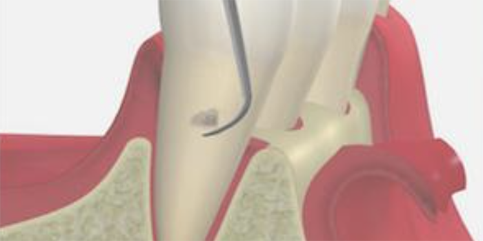 歯周外科治療(フラップ手術)のイメージイラスト