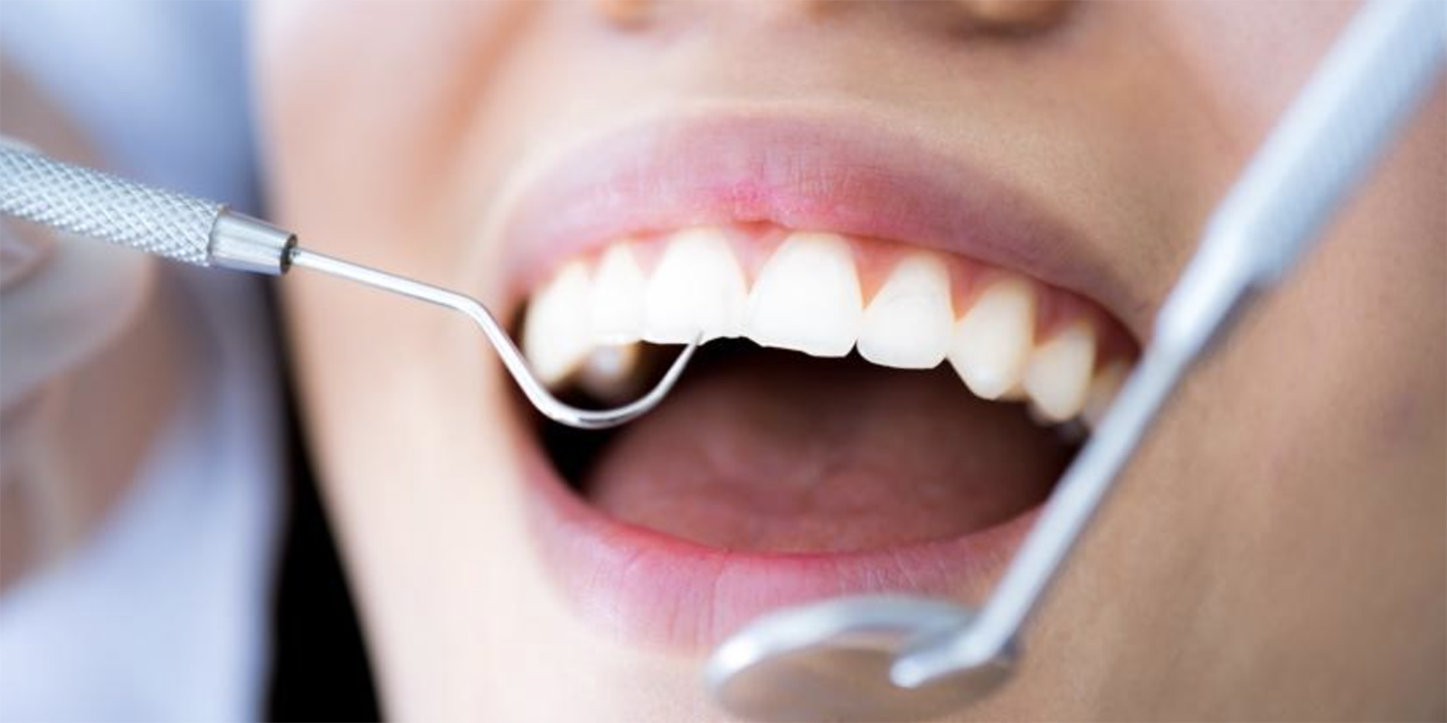 歯科医院で口腔内チェックを受けている様子