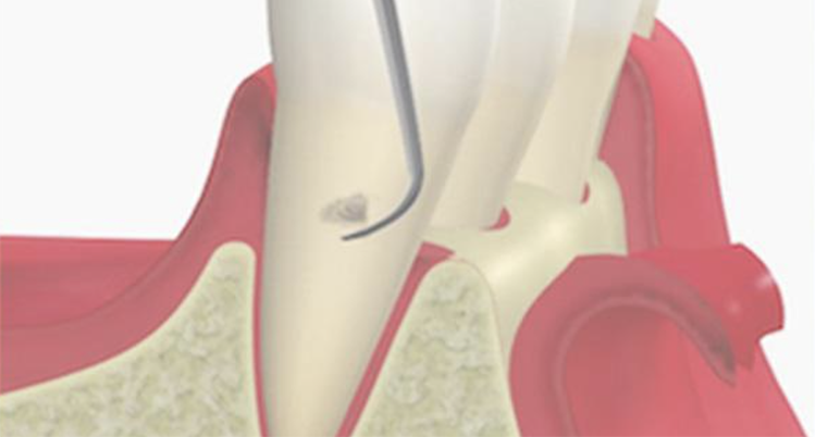 歯周ポケット掻爬術のイメージイラスト