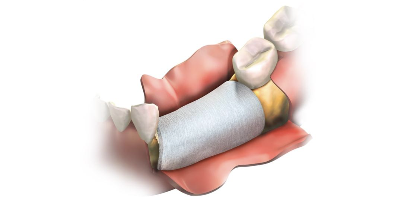 歯周組織誘導法(GTR)のイメージイラスト