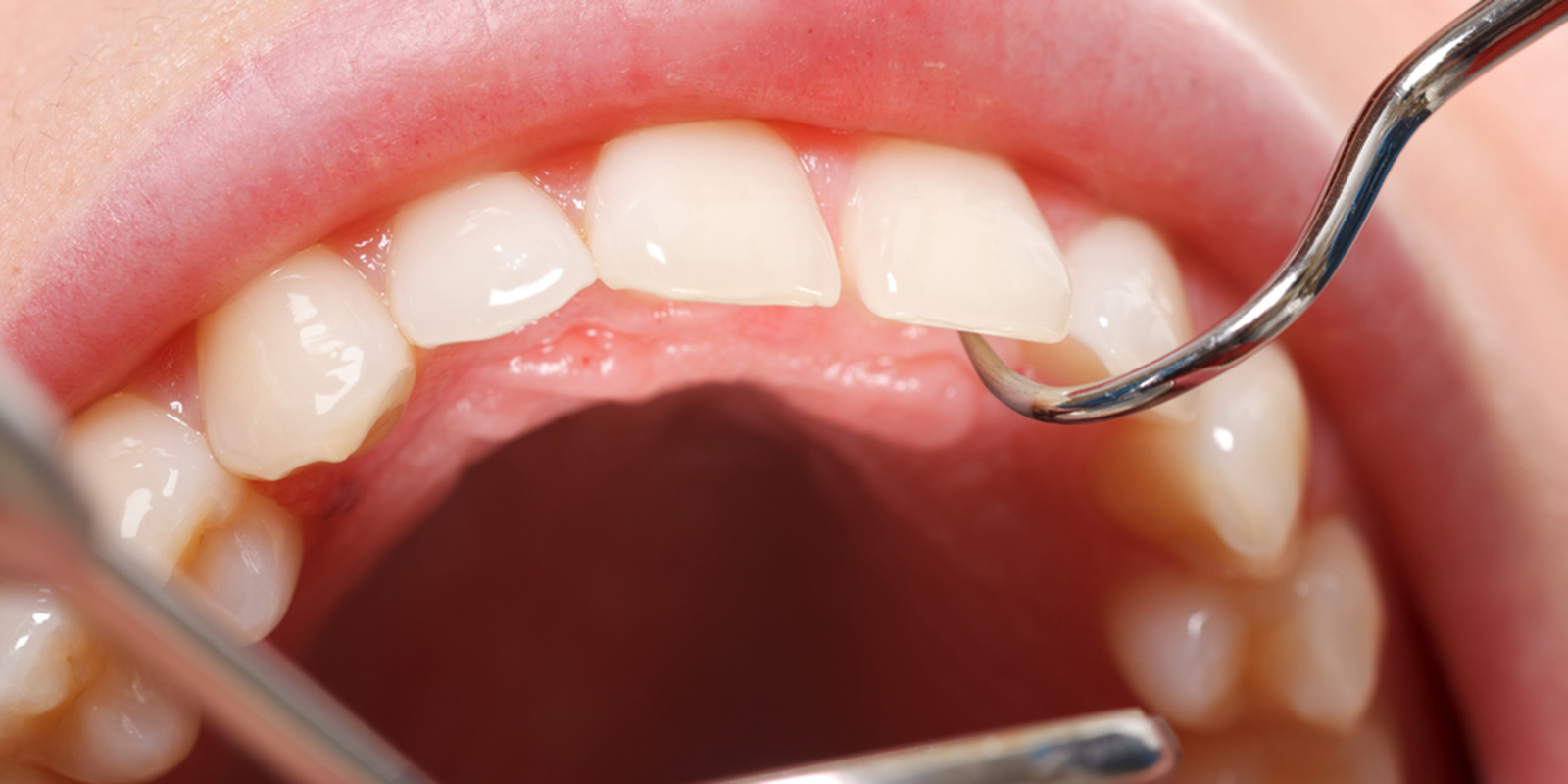 歯科医院で口腔内チェックを受けている様子