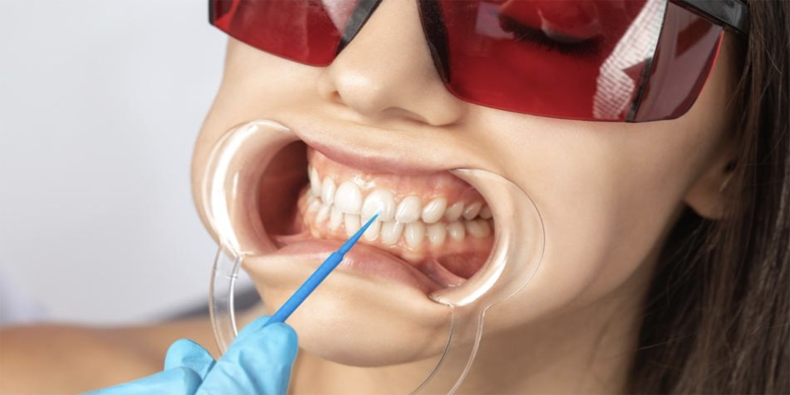 オフィスホワイトニングを受ける女性のイメージ