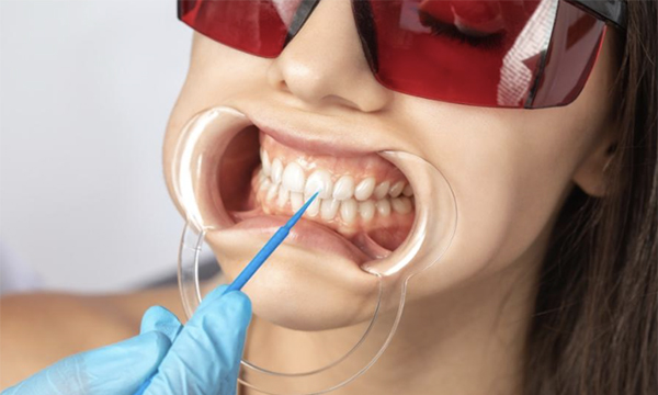 オフィスホワイトニングを受ける女性のイメージ