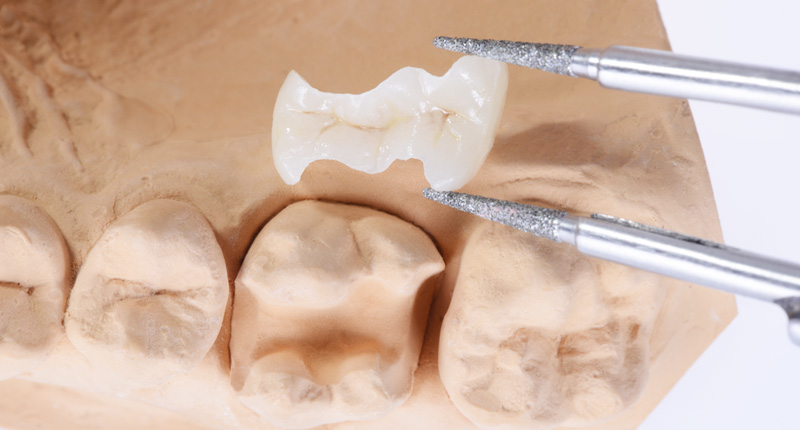 セラミックインレーをピンセットで掴んでいる画像