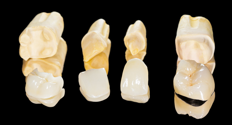 セラミッククラウンの写真