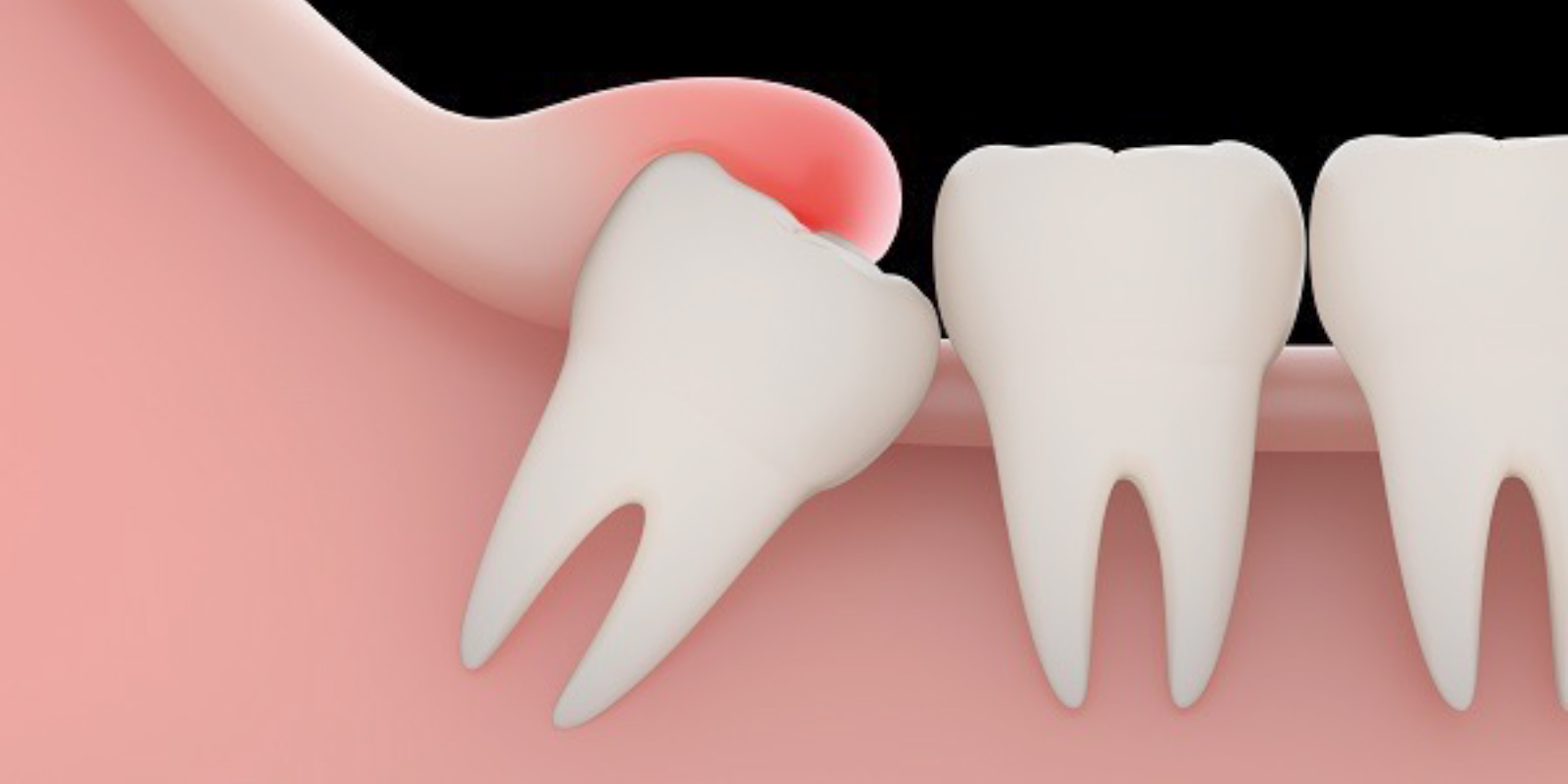 腫れた歯ぐきが乗っており完全に生えていない親知らずのイラスト