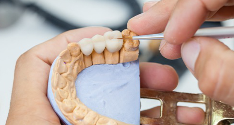 模型の上でセラミッククラウンを作製する様子