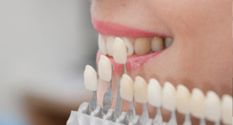 シェードガイドという色を確認するための歯の見本を歯に近づけ、色味の確認をしている様子