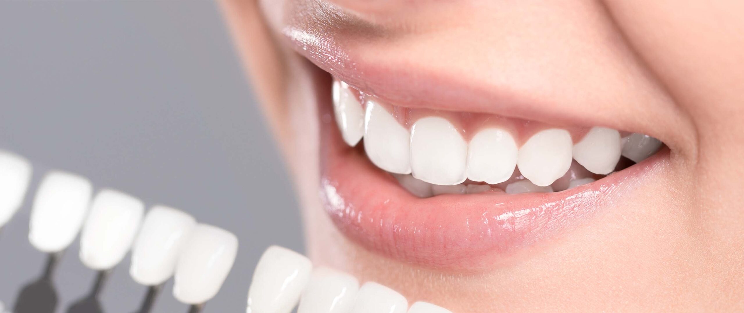 シェードガイドという色を確認するための歯の見本を歯に近づけ、色味の確認をしている様子