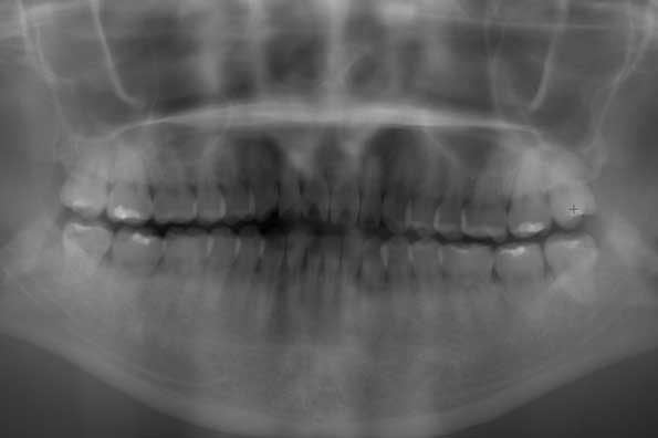 術前のレントゲン写真