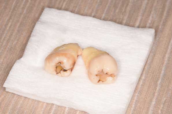 抜歯後の歯の写真