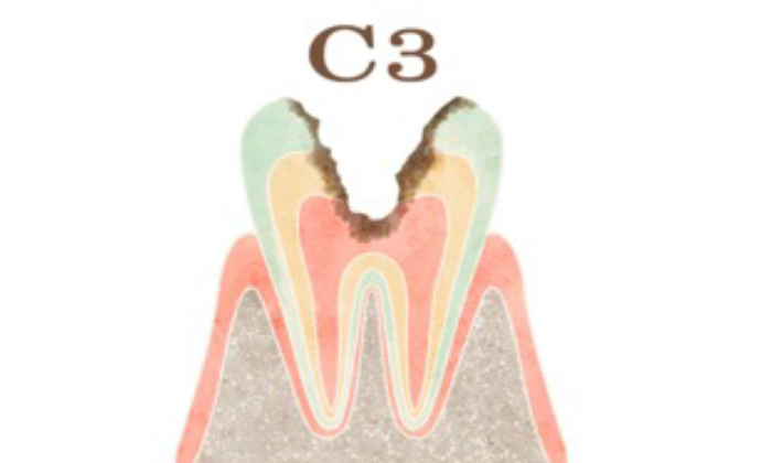 象牙質を越え神経にまで虫歯が達してしまった歯（C3）のイラスト
