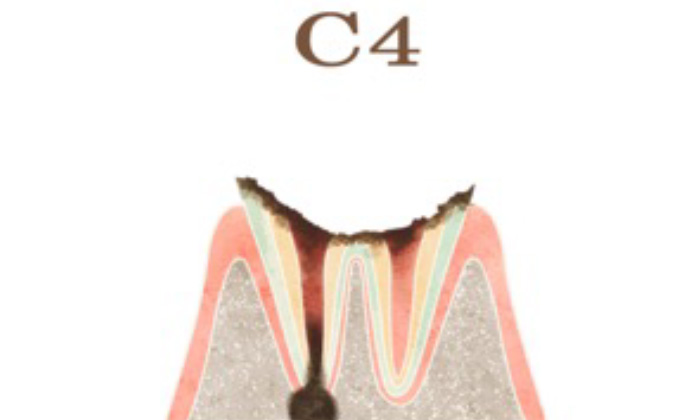 歯の頭の部分が虫歯により無くなってしまい、根だけが残った歯（C4）のイラスト
