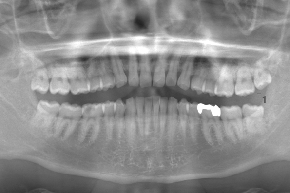 術前のレントゲン写真