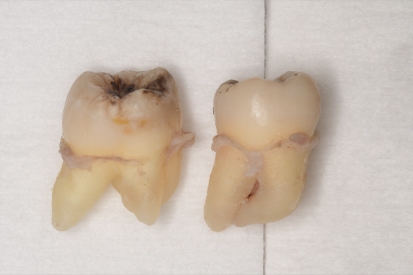 抜歯後の歯の写真