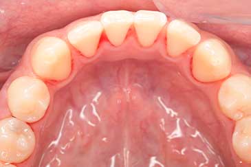 case13症例写真 施術前