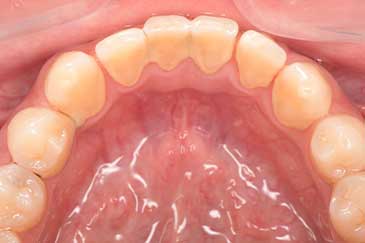 case13症例写真 施術前