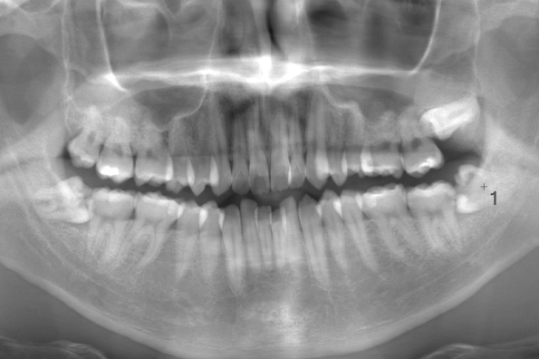 術前のレントゲン写真