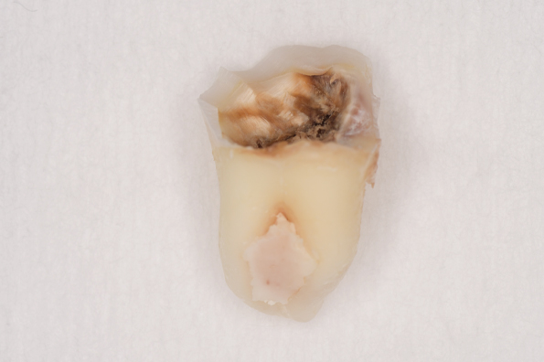 抜歯後の歯の写真