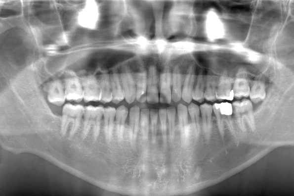 術前のレントゲン写真