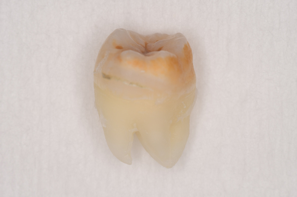 抜歯後の歯の写真