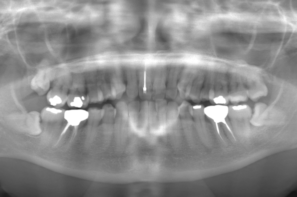 術前のレントゲン写真