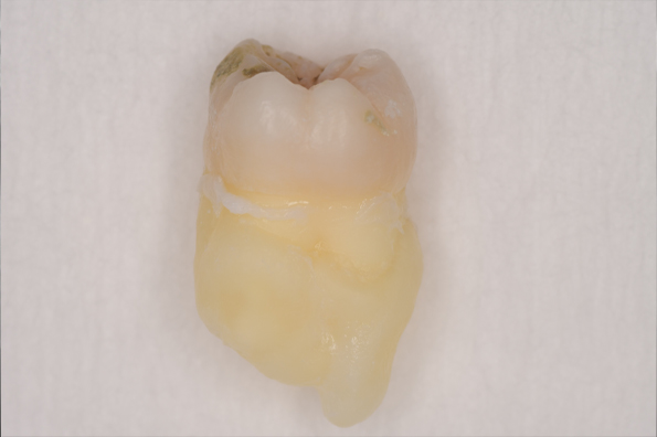 抜歯後の歯の写真