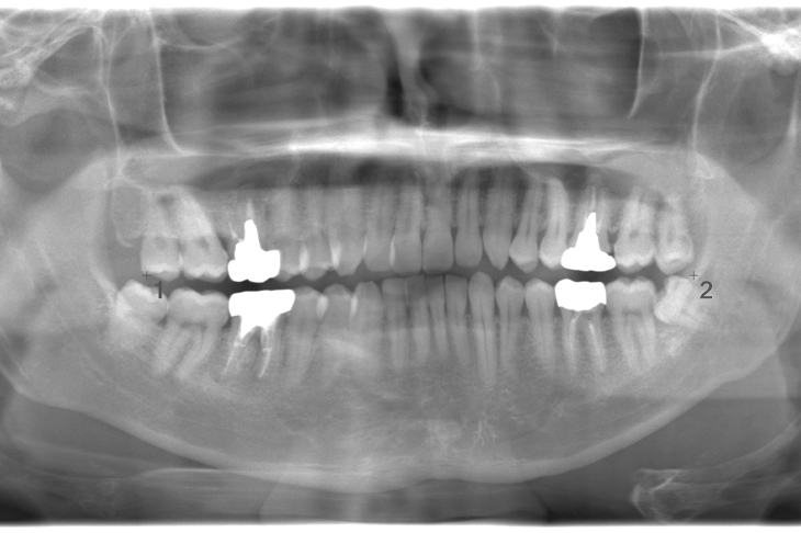 術前のレントゲン写真