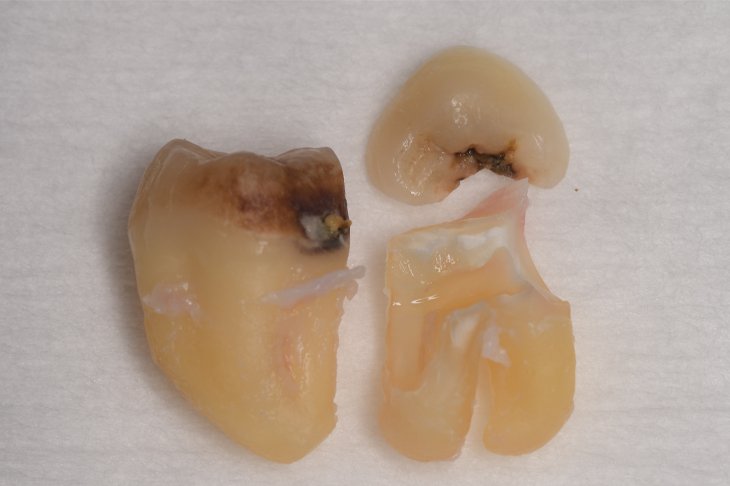 抜歯後の歯の写真