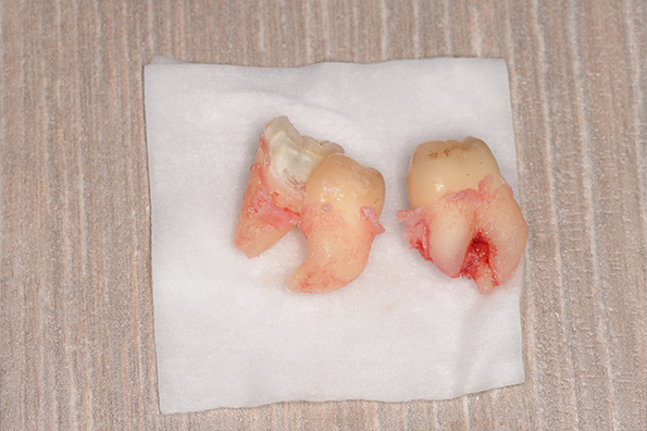 抜歯後の歯の写真