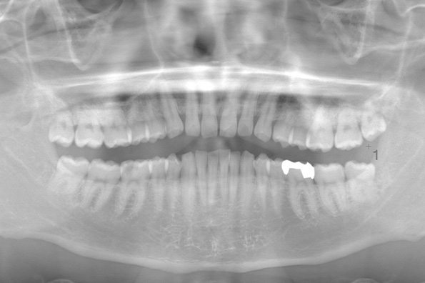 術前のレントゲン写真