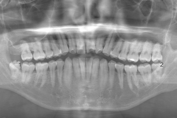術前のレントゲン写真