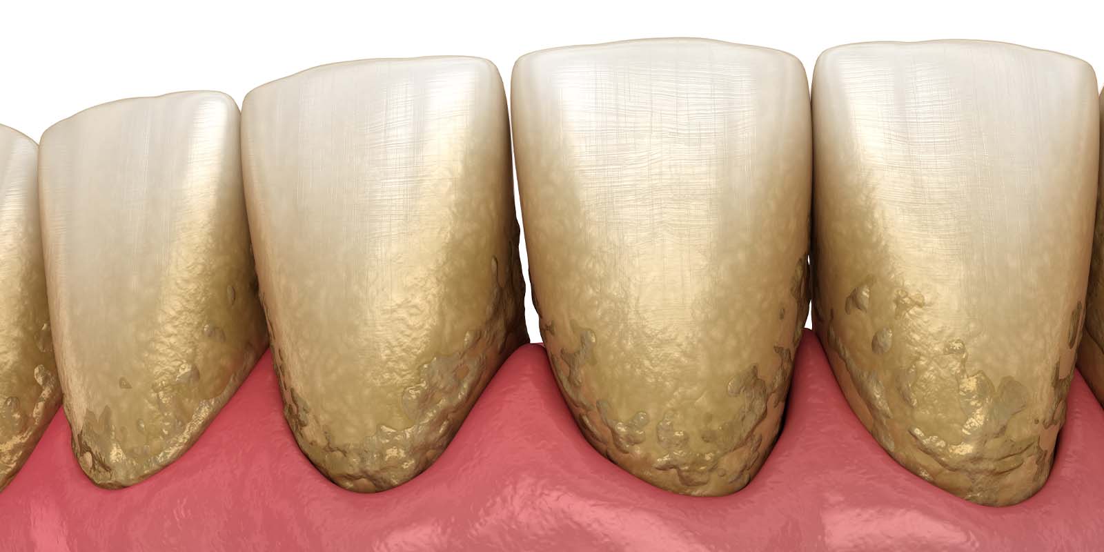 汚れが付着している口の中のイメージ画像