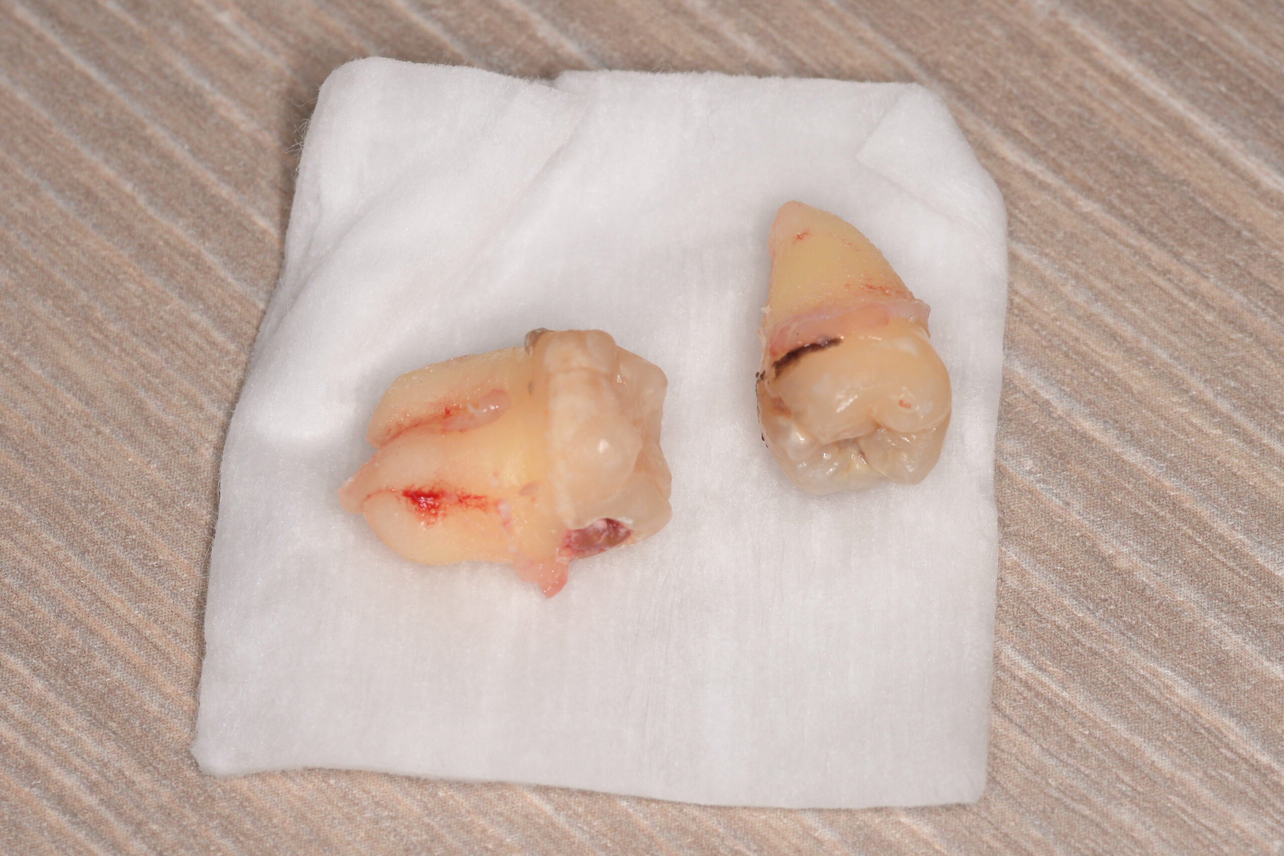 抜歯後の歯の写真